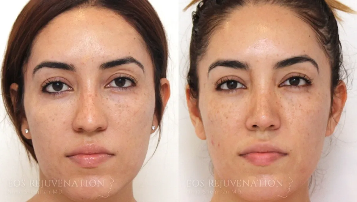 How Many Microneedling Sessions For Acne Scars StripesnVibes